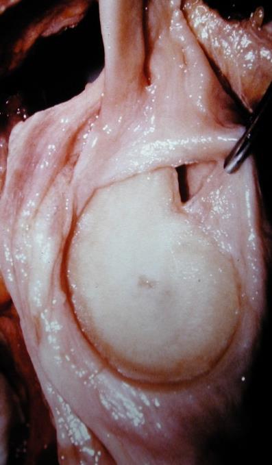 Andrews AJSM 1985 Superior labral lesions in throwing athletes Synder Arthroscopy 1990 27 / 700 arthroscopies retrospectively evaluated Injury of the superior labrum begins