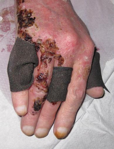 The use of ACTICOAT Flex 3 dressing in the management of a hand burn Hand burn A 79-year-old male with a