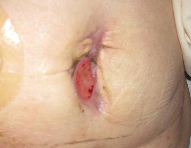 The patient complained of odour and discharge to the middle wound. ACTICOAT Flex 3 dressing was chosen with ALLEVYN Gentle Border as the secondary dressing.