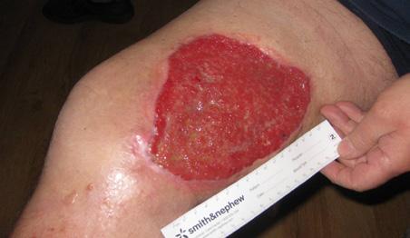 The objective was to accelerate wound healing and manage copious amounts of exudate to reduce maceration to the surrounding skin.