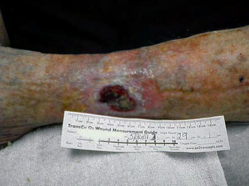 Case Study: Venous Stasis Ulcer 89 year old Caucasian female with a chronic venous stasis ulcer resulting from an unknown cause, open over