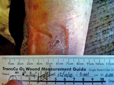 Previous therapies include: moist wound therapy (MWT) Full closure achieved with at 3 ml/hr by 33 days Time Day 0 Initiation of therapy