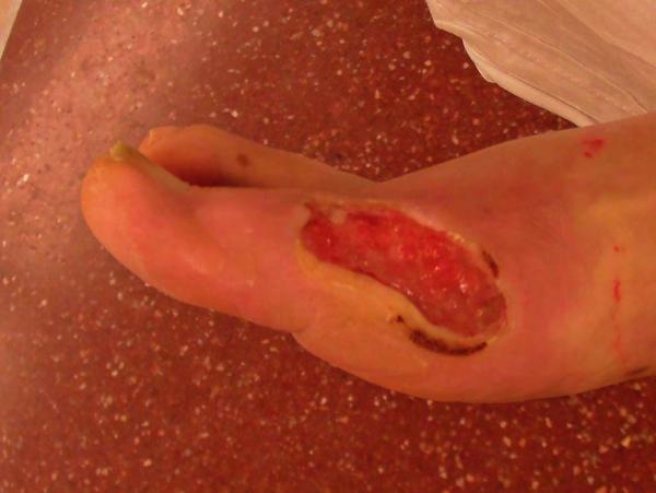 Case Study: Skin Graft Female with deep ulcer on right foot Patient has already had partial amputation of left foot from similar