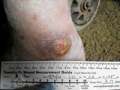 Case Study: Diabe<c Foot Ulcer 61 year old Caucasian male with a diabetic ulcer on the left ankle for over 45