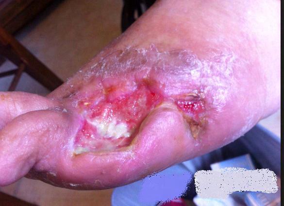 Case Study: Diabe<c Foot Ulcer 54 year old female with a non-healing diabetic foot ulcer, open 90 days Comorbidities: diabetes