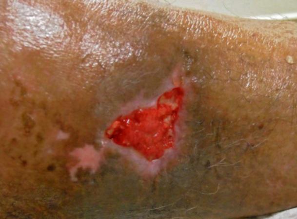 Case Study: Diabe<c Foot Ulcer 64 year old Hispanic male with non-healing diabetic ankle ulceration Age of wound greater than 2 months