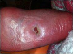 Case Study: Diabe<c Non- Healing 65 year old Caucasian male with non-healing diabetic wound Age of wound