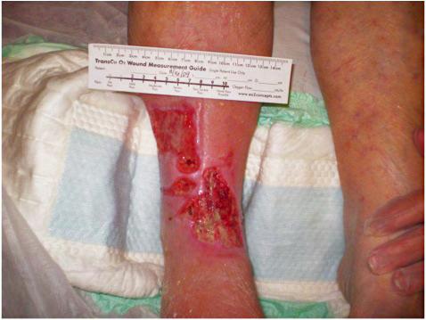 Case Study: Venous Stasis Ulcer 89 year old female with chronic non-healing venous stasis ulcer on right leg History of: diabetes type II,