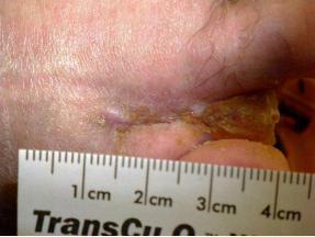 Case Study: Dehisced Surgical Wound 63 year old Caucasian male with diabetes and osteomyelitis has a dehisced amputation wound open greater than 60 days Previous therapies include: intravenous and
