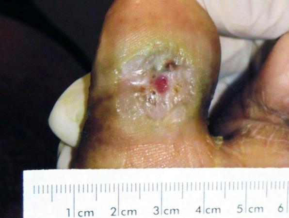 Case Study: Toe Pressure Ulcer Diabetic female with non-healing pressure ulcer on great toe for greater than two