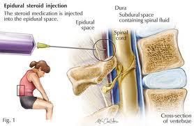 EPIDURAL STEROID INJECTION: An epidural steroid injection is an injection into the epidural space of the spine.