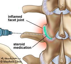 FACET JOINT & MEDIAL BRANCH BLOCKS: These injections target pain that may eminate the facet joint of the spine at any given level.
