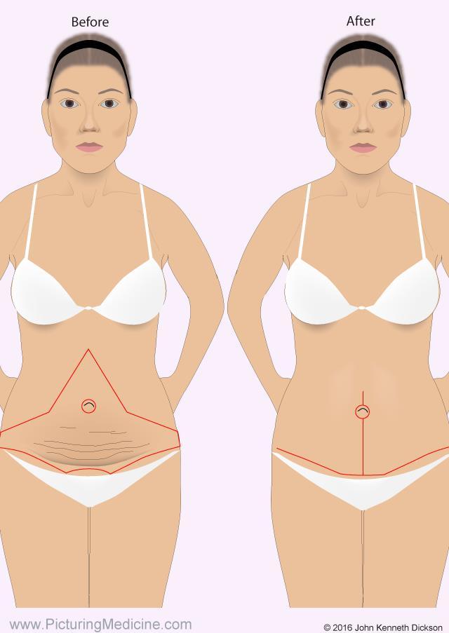 The fleur-de-lis tummy tuck (diagram 3) For patients with lots of extra skin on the lower and upper tummy, a fleur-de-lis tummy tuck might be appropriate.