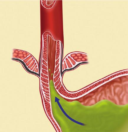 stomach into the esophagus. The LES is a muscle at the junction of the esophagus and stomach that functions as the body s natural barrier to reflux.