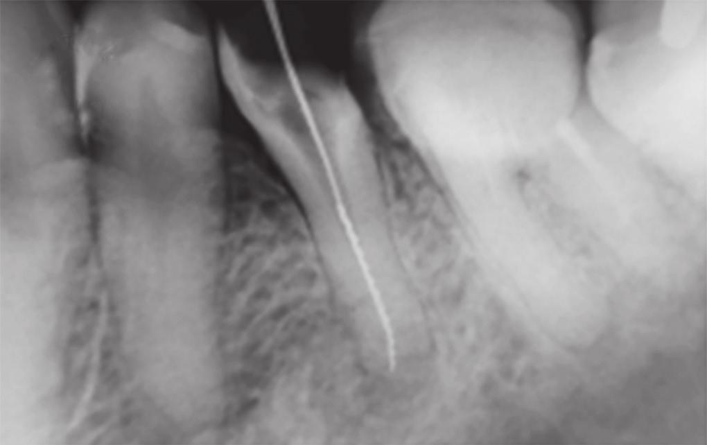 After trying to remove food debris, the patient made a sudden lever movement, causing the separation of nonendodontic instrument within the root canal, verified
