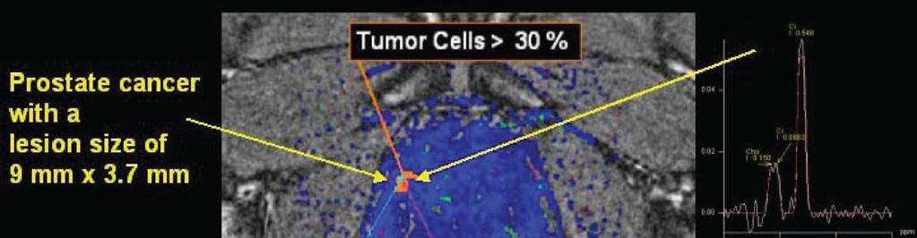 7 mm and a cancer cell density of >30% was detected by DCE-MRI (orange lesion); but MRS shows a normal spectrum
