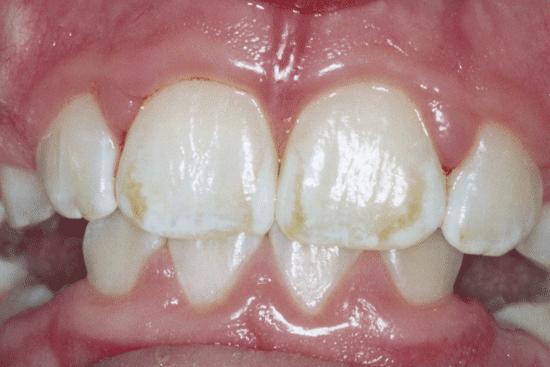 Fluoride Func:ons Promotes the deposi:on of calcium and phosphate in bones and teeth Food sources Fluoridated water Balance Excess can cause fluorosis: discolora:on and specks on teeth; weakens teeth.