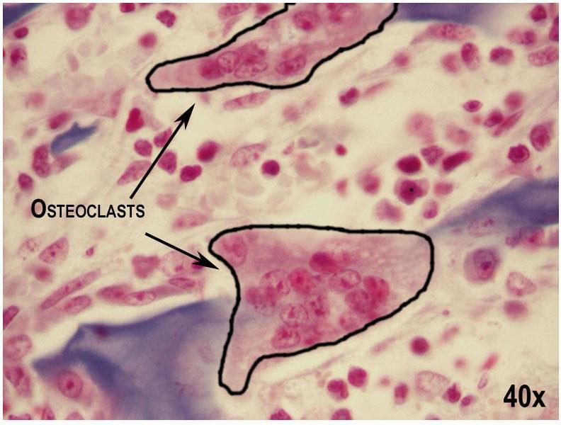 Osteoclasts From the Greek: bone + broken Responsible for bone resorption (secretion of an acid and a collagenase to destroy bone