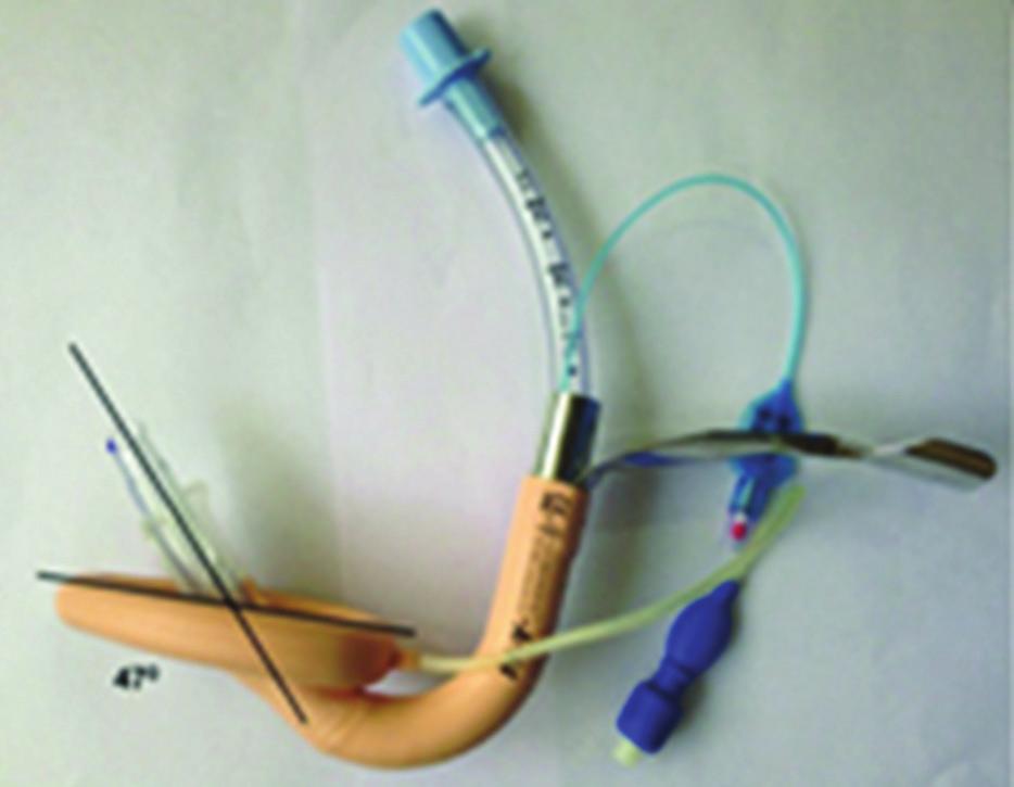Figure 1: Angle of emergence of conventional endotracheal tube through intubating laryngeal mask airway in reverse orientation Figure 2: Angle of emergence of conventional endotracheal tube through