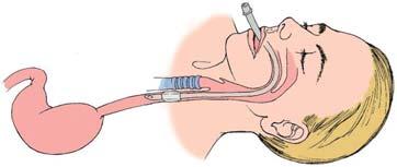 Confirm placement If sounds are only present in the epigastrium, an esophageal intubation has occurred Slide 37 An unrecognized esophageal intubation is fatal Slide 38 Confirm placement Deflate