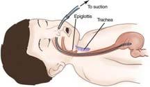 Insertion procedure Prepare and assemble all equipment Measure tube from tip of nose, around ear to below the xiphoid process Lubricate distal end of tube If trauma is not suspected, place