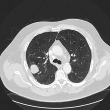 Case One 64 year old, Caucasian, male former smoker diagnosed with stage IV non small cell lung cancer,