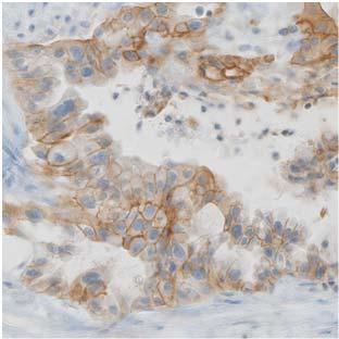 PD-L1 IHC Examples from daily practice TC <1%; IC >10%
