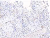 Comparability among five assays on tumor cell staining