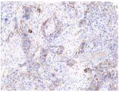 cell staining, but with greater variability than tumor cell