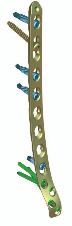 Features and benefits Increased hole density provides improved anchorage In the distal part of the plate a tight network of 3.5 LCP combination holes allows inserting the screws closer to each other.