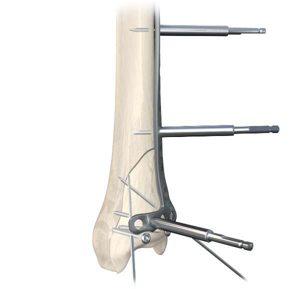 Section A: Anterolateral Distal Tibia Locking Plate Plate Positioning Position the plate and reduce the fracture manually.
