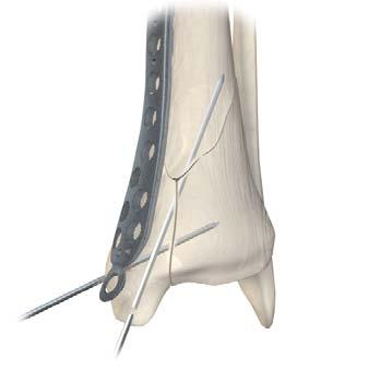 Plate Positioning Insert the plate using percutaneous insertion through the distal incision for a