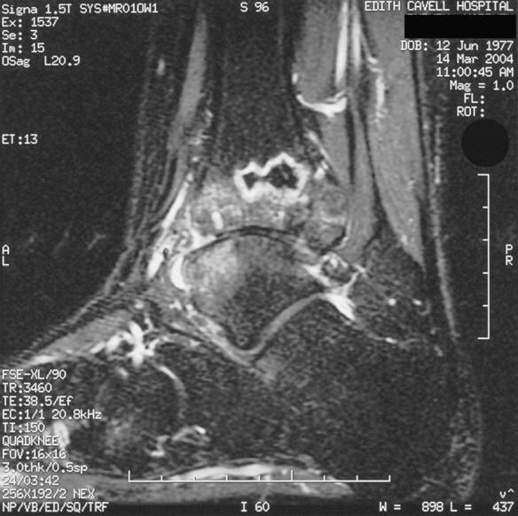 Post-traumatic osteonecrosis of distal tibia 265 Case report A 25-year-old man sustained a fracture dislocation of his left ankle with a high fibular fracture when he was knocked down by a push-bike