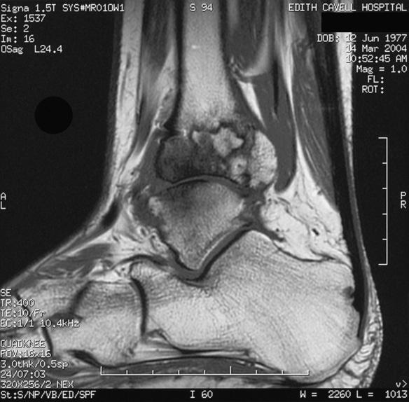 He was seen in our unit 4 days later and the ankle was re-manipulated to correct mild talar shift and immobilised in plaster. Surgery was delayed due to gross swelling around the ankle.