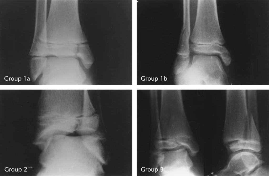 J Pediatr Orthop Volume 25, Number 4, July/August 2005 Physeal Injuries of the Distal Tibia With Intra-Articular Involvement FIGURE 1. The three groups of our proposed classification.