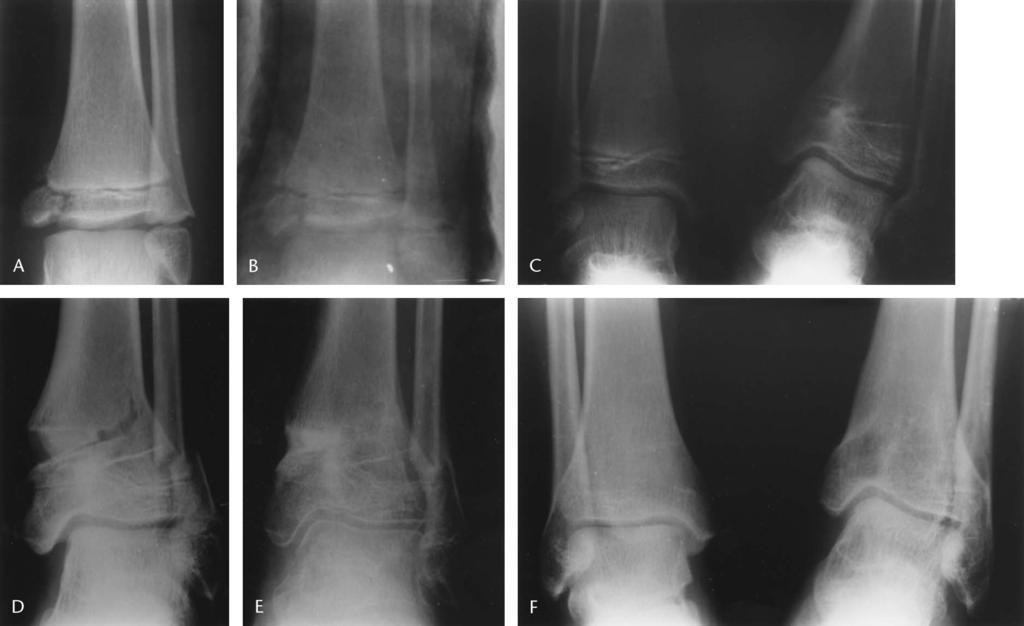 J Pediatr Orthop Volume 25, Number 4, July/August 2005 Physeal Injuries of the Distal Tibia With Intra-Articular Involvement FIGURE 4. A, Group 1a injury in a boy age 11.