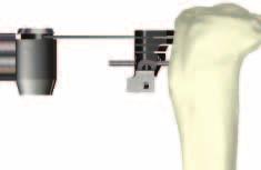 Loosen the vertical adjustment thumbscrew on the shaft of the Alignment Guide. Extract the two headed Fixation Pins on the top of the Alignment Guide from the proximal tibia.