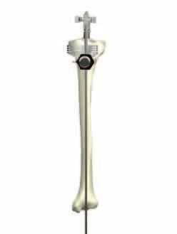 GMRS Distal Femoral Surgical Protocol LOCKING BUTTON TIBIAL STYLUS EXTERNAL ALIGNMENT ROD TIBIAL RESECTION GUIDE THUMBSCREW Figure 43 Attach the Alignment