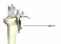 Secure the Tibial Resection Guide/Tibial Stylus Assembly to the IM Tibial Alignment Guide by retightening the thumbscrew (Figure 45).