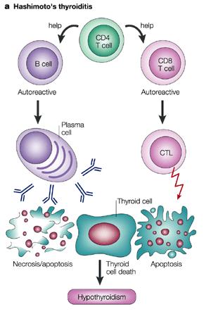 Slika 1. Kod Hashimotovog tiroiditisa limfociti T CD4 + regrutiraju limfocite B i limfociti T CD8 +.