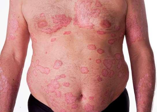 Obesity and Psoriasis Obesity = chronic inflammatory state Obese patients have higher risk of severe disease and reduced response to therapy Adipocytes