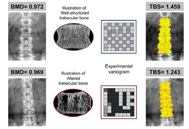 TRABECULAR BONE SCORE (TBS) TRABECULAR BONE SCORE (TBS) TBS is a texture analysis parameter which correlates with micro-architecture parameters Silva et al.
