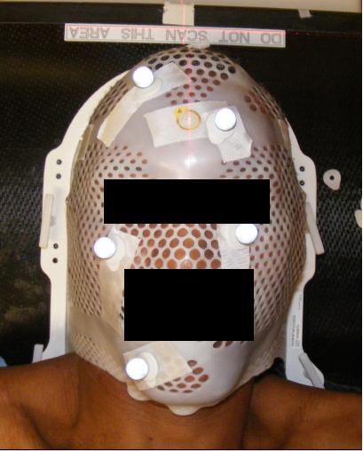 6 Figures Figure 1. The patient supine with a customized aquaplast mask.