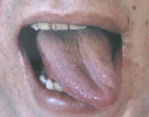 Lacerations of the tongue