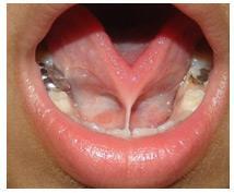 to large frenulum) Lesion of the