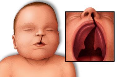 Cleft palate: Unilateral Bilateral