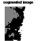 6 shows the classification of cancerous images Figure5: Region of interest Figure3: Query image