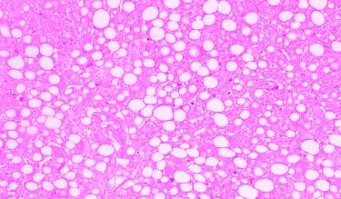 Regression: 18%-22% Isolated steatosis Steatosis with