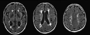 Acute infarcts progress to WMH 5 patients with WMH underwent MRI weekly for 16 consecutive weeks.