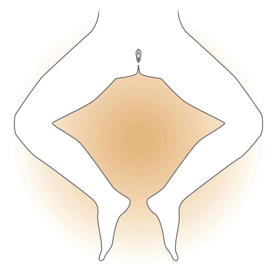Self-Intermittent Catheterization Instructions for Women continued 4. Lay out the equipment so it is within easy reach. Open the water soluble lubricant and catheter package.